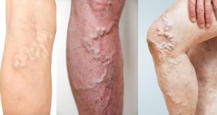 Deep Vein Thrombosis