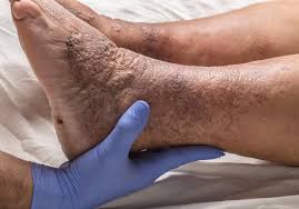 Deep Vein Thrombosis